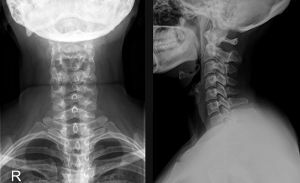 X-lúč krčnej chrbtice