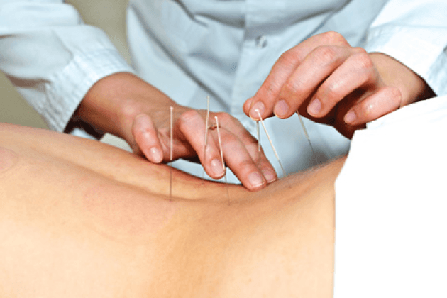 Akupunktur er vellykket brukt til å behandle intervertebral brokk