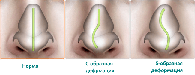 Types of curvature of the septum of the nose