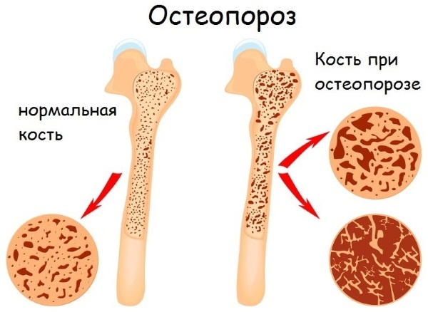 Exercises for osteoporosis in old age of the spine, hip joint, lumbar spine