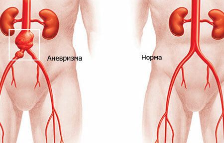 Aneurysma der Aorta: Symptome, Behandlung, Diagnose der Aorta