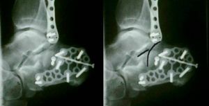 X-ray of the heel fracture