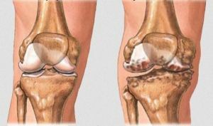 artritída kolena