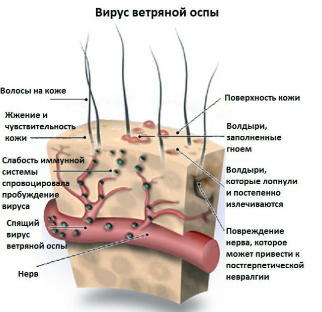Učinek virusa varicella-zoster na človeško kožo