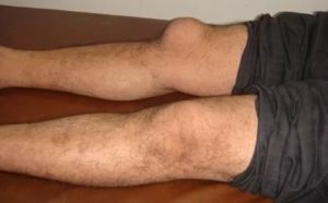 Bursitis koljena