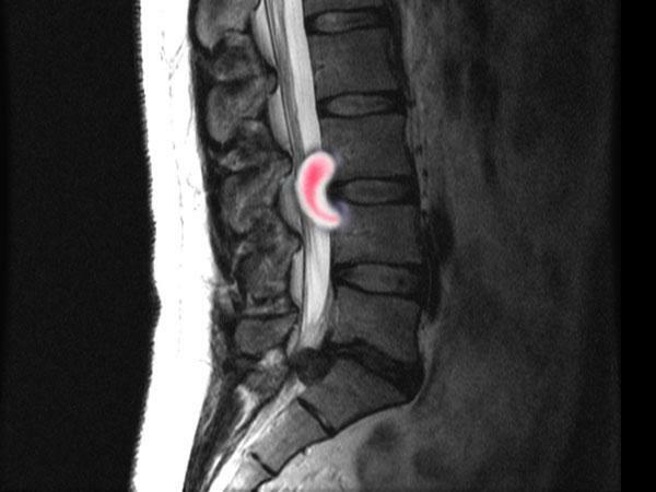 MRI dengan osteochondrosis pada tulang belakang lumbosakral