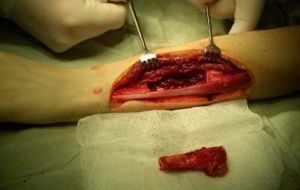 Kirurgi for at fjerne tumoren