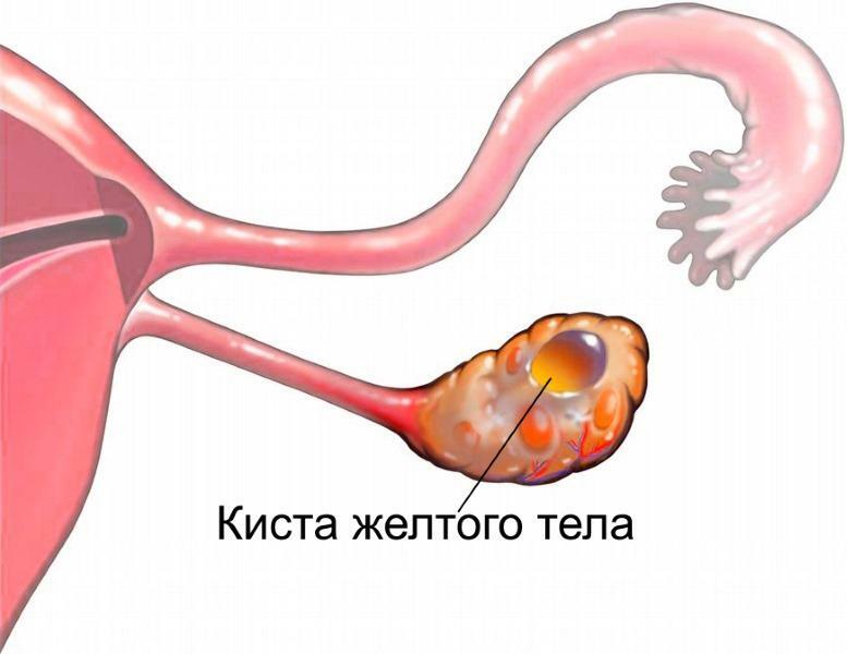 Chistul chistului ovarian: simptome, prim ajutor și tratament