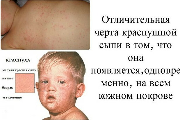 Rubella rash. Photo, diff. diagnosis, diagnosis