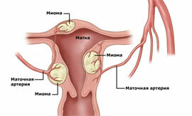 Myoma subsetente do útero