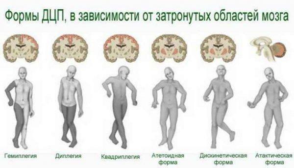 Formen der Zerebralparese