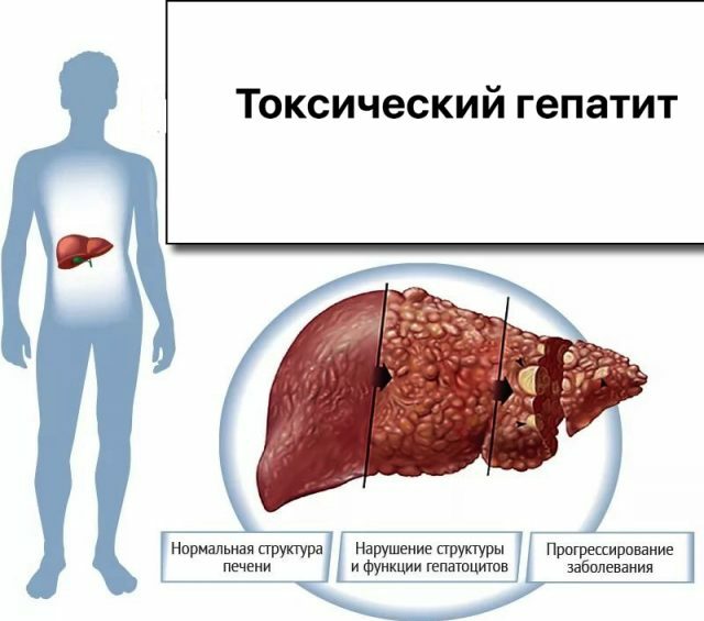 Akute und chronische toxische Hepatitis: Symptome, Behandlung, Diät und andere Aspekte