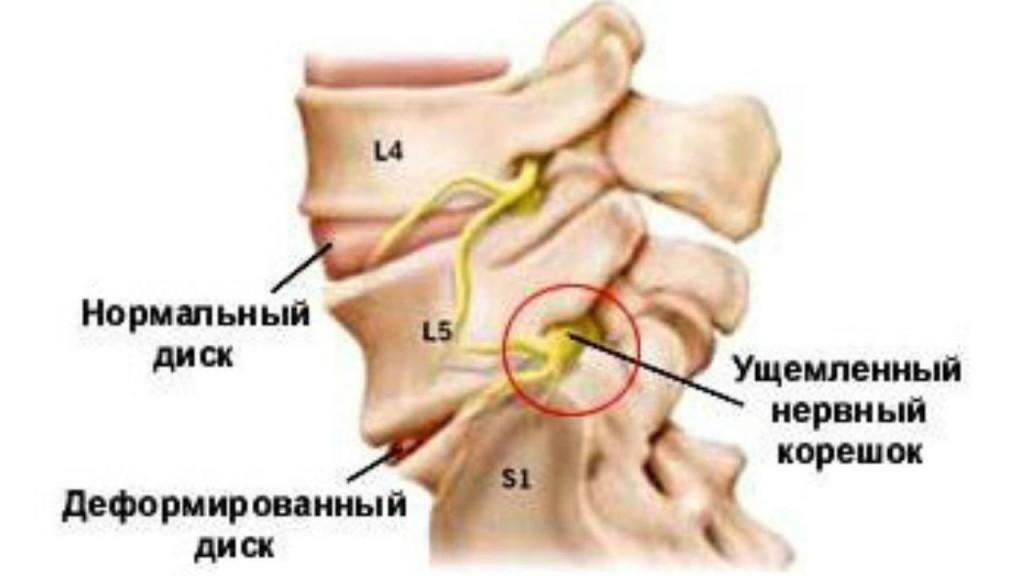 Tanda osteochondrosis pada tulang belakang leher rahim - deskripsi mendetail!
