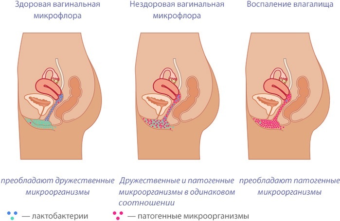 Retrodeviation of the uterus. What is it, degrees, how to treat, get pregnant
