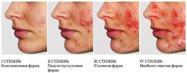 Small purulent pimples on the face of women. Causes and treatment, how to get rid
