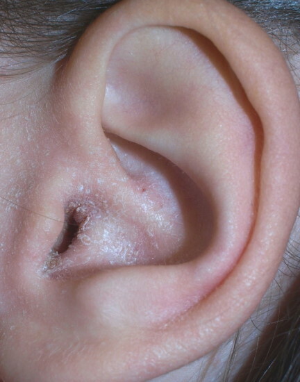 Plaque blanche dans les oreilles de l'enfant, derrière l'oreille, à l'intérieur. Que faire