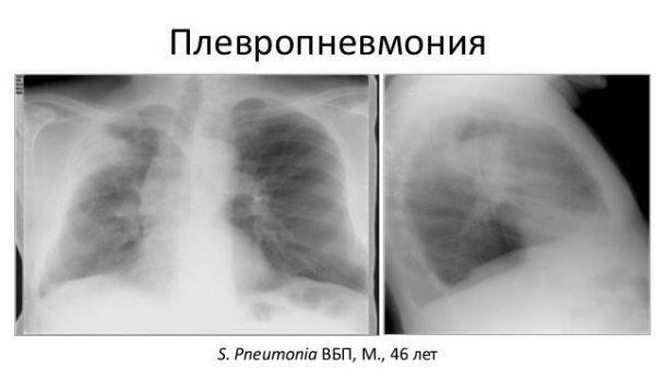 Pleuropneumonija