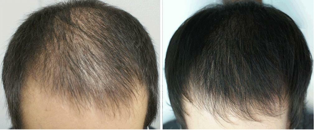 Before and after vacuum massage of the scalp