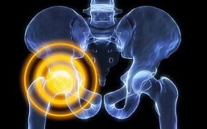 arthritis of the hip
