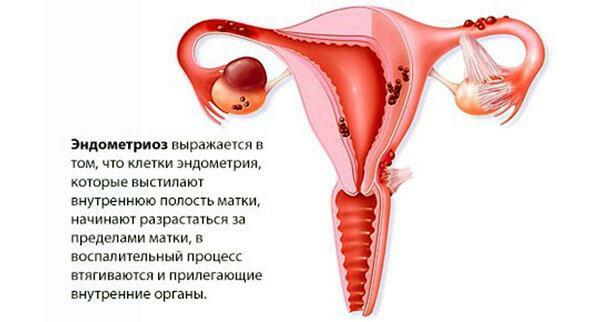 Kas yra endometriozė?