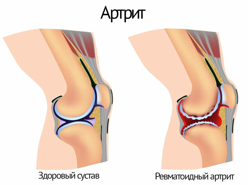 Forms and types of knee arthritis