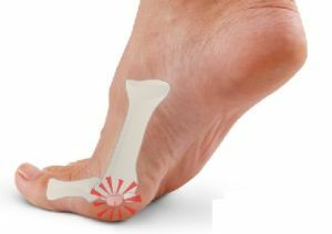 métatarsalgie du pied