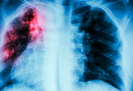 Treatment of pulmonary sarcoidosis
