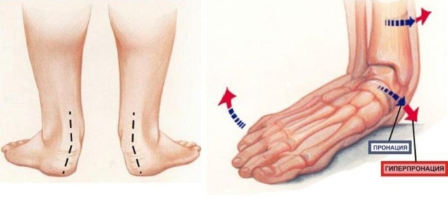Pronation of the foot is what this