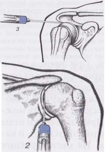 Blockade of the shoulder joint