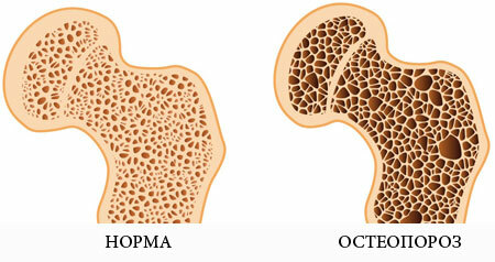 Osteoporoze