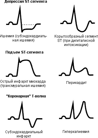 Elevation of the ST segment on the ECG. What is it: v1-2-3, as evidenced by