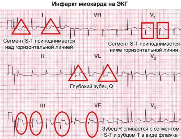 Myocardial infarction: what to do, first aid