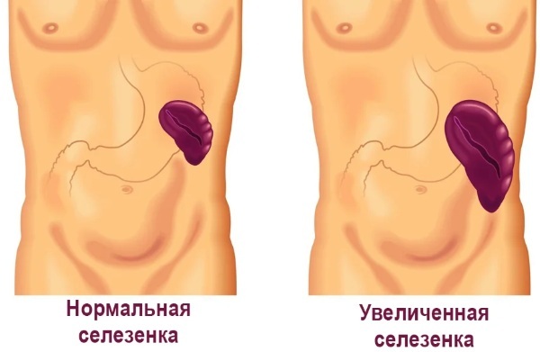 Splenomegaly. What is it, how to treat, causes of moderate, minor, portal, severe, analyzes