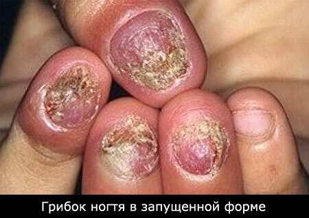 Treatment of nail fungus neglected form