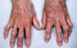 artróza prstov