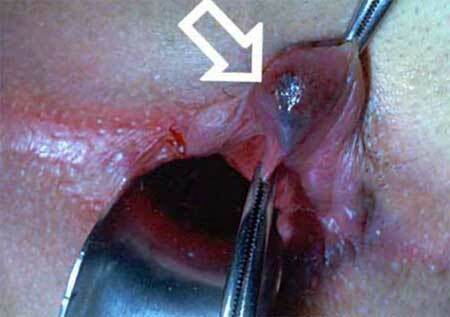 Trombose van de hemorrhoidale knoop - behandeling, ernst