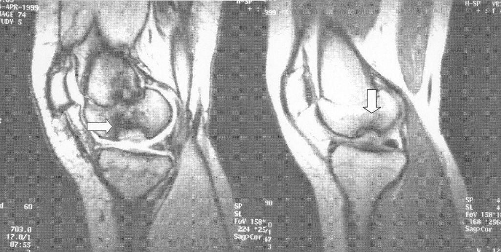Doença de König da articulação do joelho - diagnóstico e tratamento!