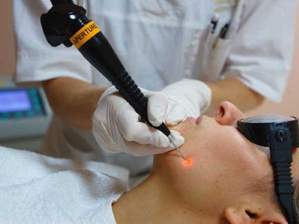 Removal of moles on the face by radio wave, nitrogen, Surgitron. Price