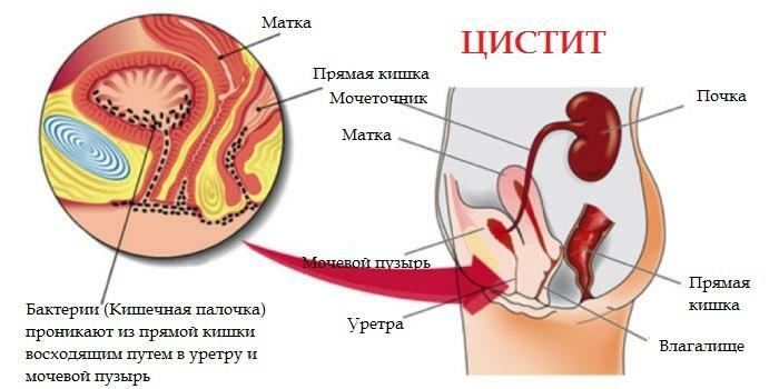 Cistitis kod trudnica: što liječiti - više informacija