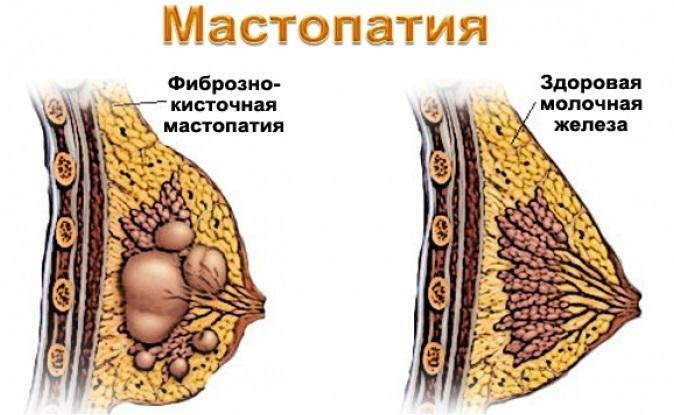 Cómo se ve la glándula mamaria con mastopatía
