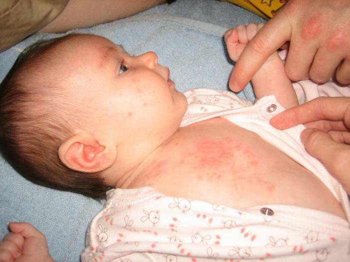 El cuidado escrupuloso del bebé ayudará a evitar la aparición de sudoración