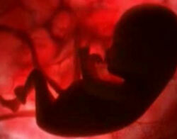 Trombofilija nėštumo metu