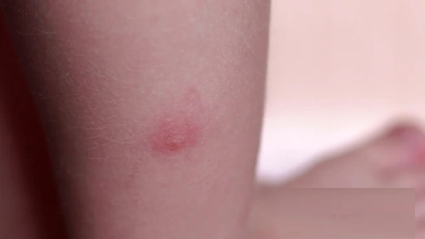 Flea bite on a person. Photos, what it looks like, how to treat, prevention, types of diseases
