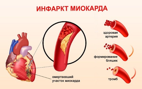 Heart attack in women under 40, older than 50-60 years. Symptoms, effects, the body recovery