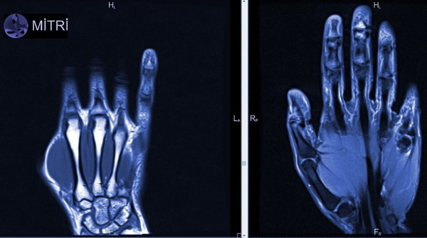 MRI של היד. מה מראה כיצד היא מתבצעת, מחיר, הכנה
