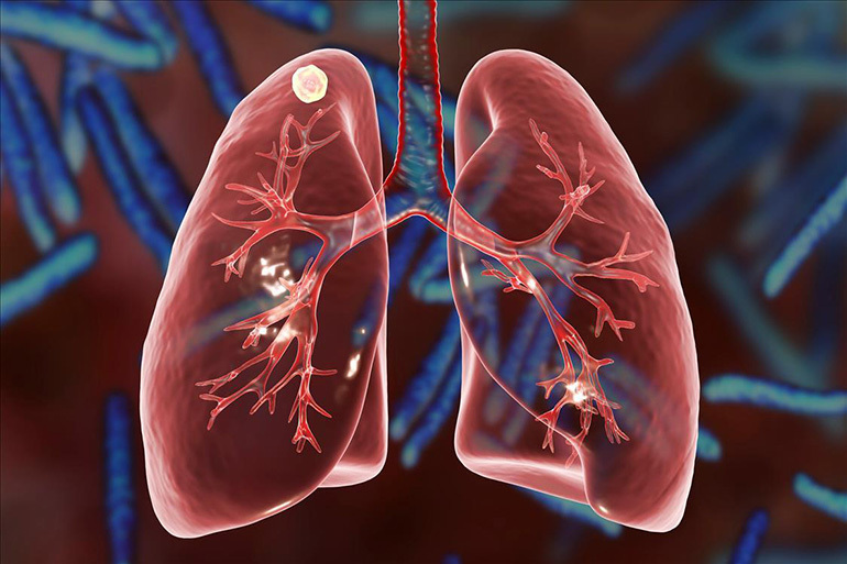 Tuberculosis pulmonar focal: características generales