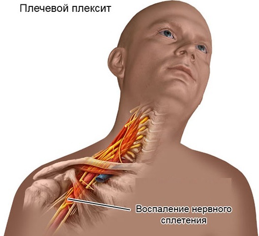 Brachial nerve plexitis. Drug treatment, symptoms