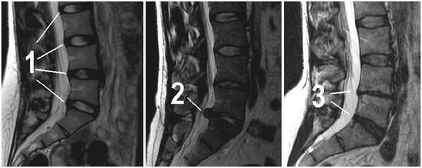 Disc herniat de coloană lombară în imagini
