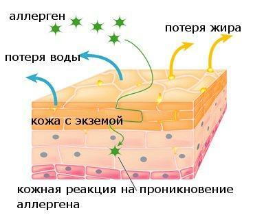 The appearance of eczema on the skin