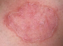 Årsager til Skin Mycosis